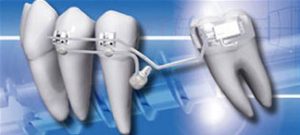 Temporary anchorage device in braces